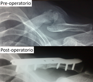 figura 1 pseudoartrosi clavicola