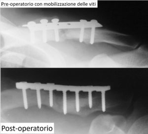 figura-2-pseudoartrosi-clavicola