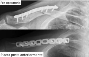 figura-3-pseudoartrosi-clavicola