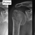 figura-7-frattura-prossimale-omero