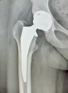 protesi-anca