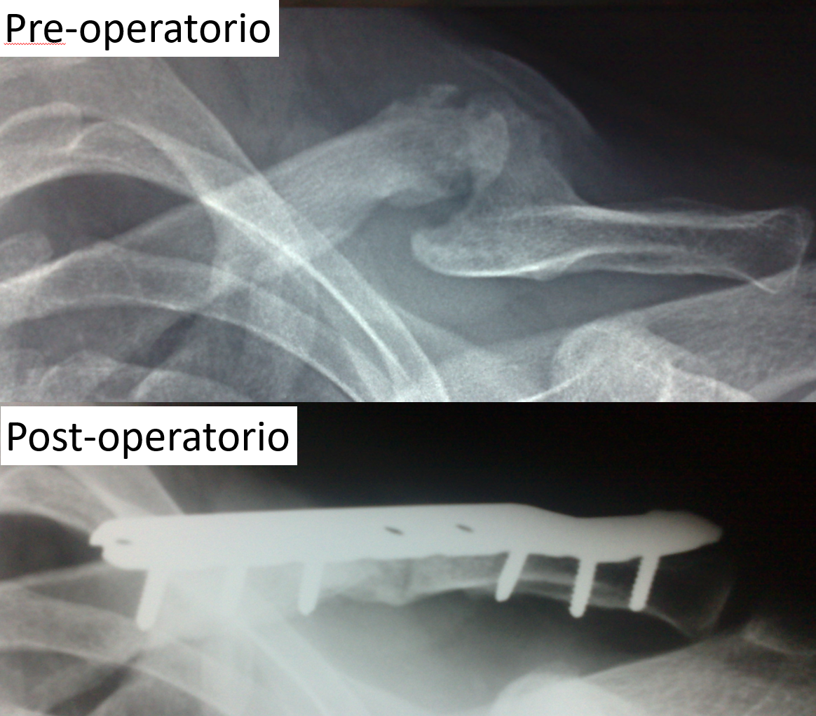 figura 1 pseudoartrosi clavicola figura 1 pseudoartrosi clavicola