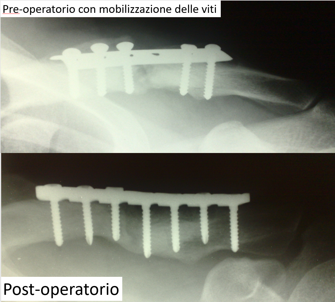 figura 2 pseudoartrosi clavicola figura 2 pseudoartrosi clavicola