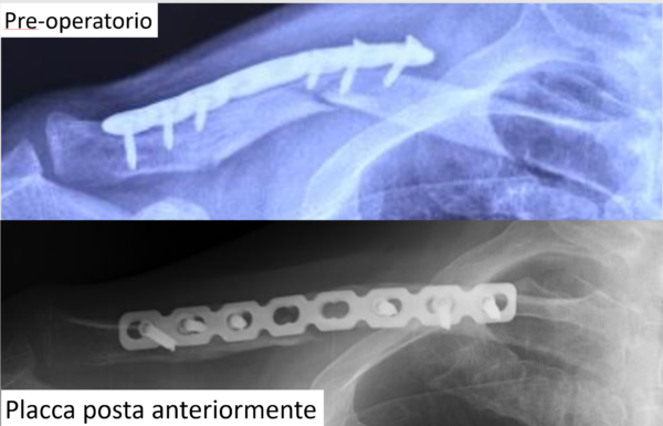 figura 3 pseudoartrosi clavicola
