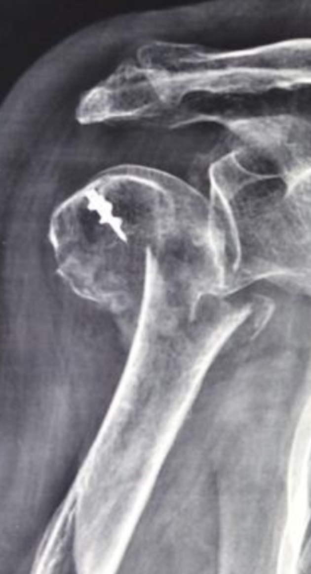 figura1 frattura prossimale omero